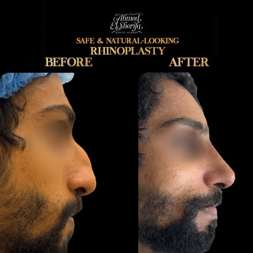 تجميل الأنف الجراحي في الرياض